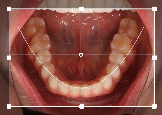 editor with the parabolic arch on an upper occlusal